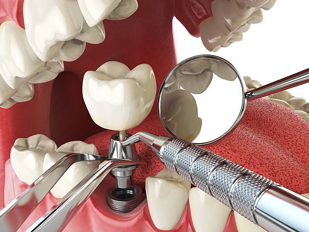 Best Emergency Root Canal Treatment in West Terre Haute, IN